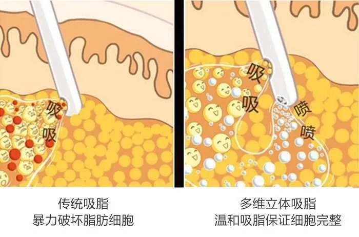 面部吸脂术后疤痕与皮肤松弛问题解析