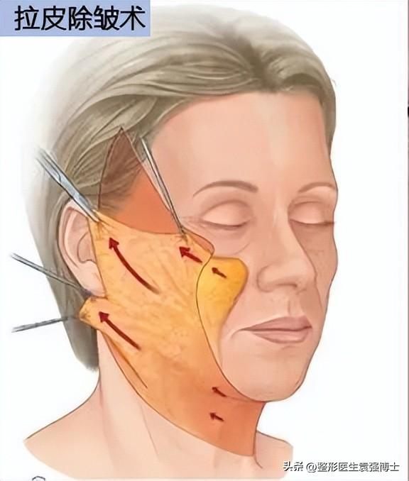 关于拉皮手术最全指南，送给45岁后需要的人（医生整理）