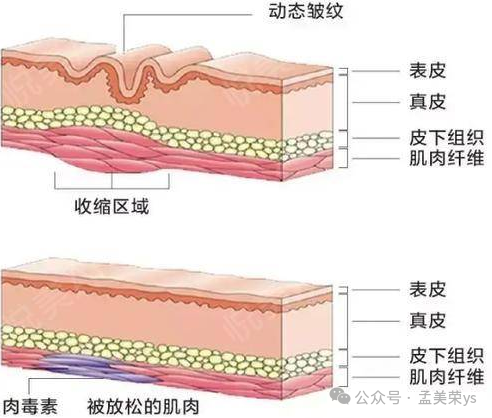 整形医生孟美荣解析除皱针打一次就能永久有效吗？